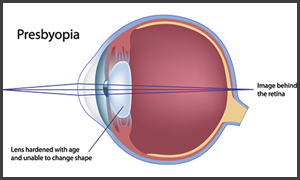 Presbyopia in Hurst