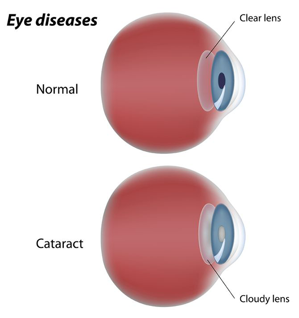 Cataracts in Hurst